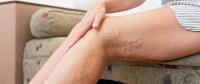 Jak pozbyć się żylaków nóg? Skuteczne porady