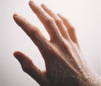 Dlaczego pęka skóra na palcach?